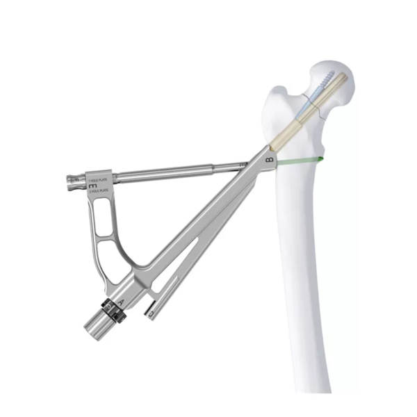 FNS (Sistema de cuello femoral)