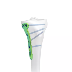 Placa de bloqueo para osteotomía tibial medial proximal