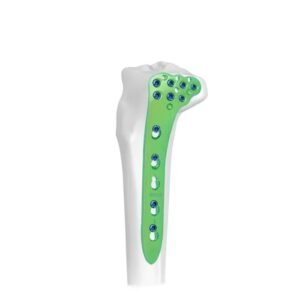 Placa de bloqueo tibial lateral proximal-I 2