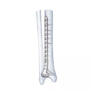 Placa de bloqueo tibial medial proximal 2