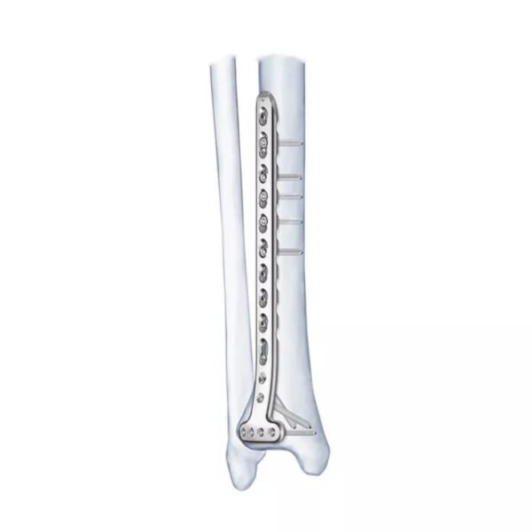 Placa de bloqueo tibial medial proximal 2